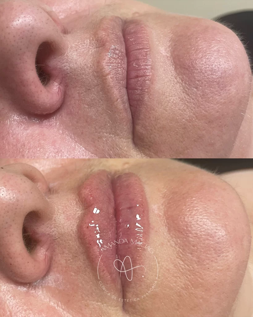 Antes e Depois Clínica Dra. Amanda Maciag 1 (1)