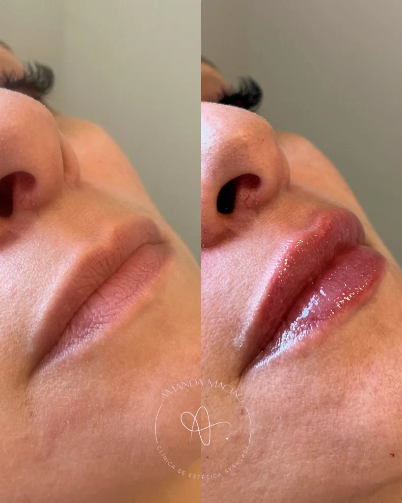 Antes e Depois Clínica Dra. Amanda Maciag 2 (2)