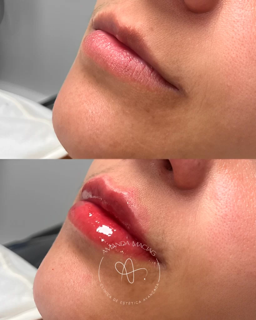 Antes e Depois Clínica Dra. Amanda Maciag (5)